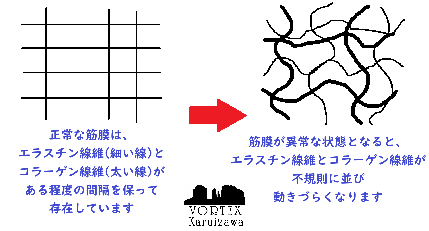 筋膜に異常が生じているってどういう状態？